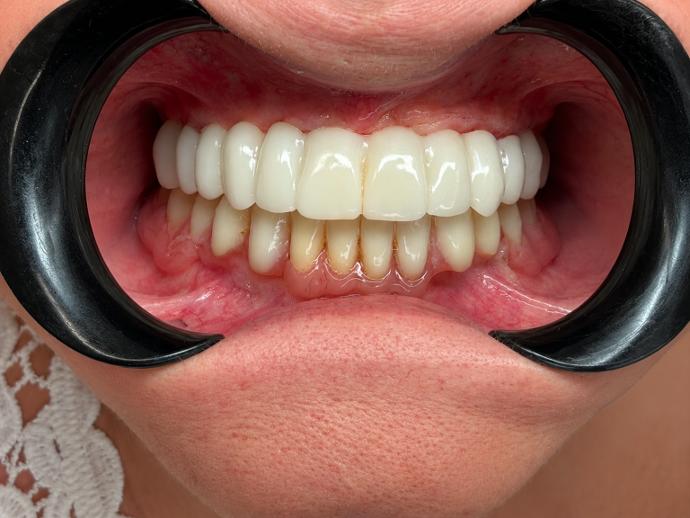 Denti fissi ad Avellino Implantologia a carico immediato