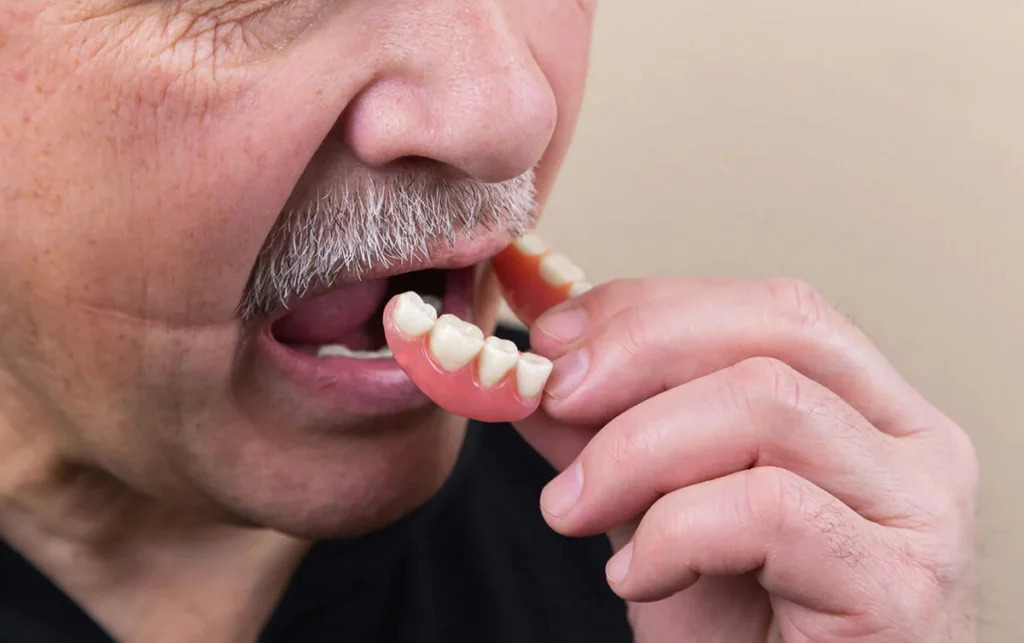 Da dentiera mobile a denti fissi ad Avellino